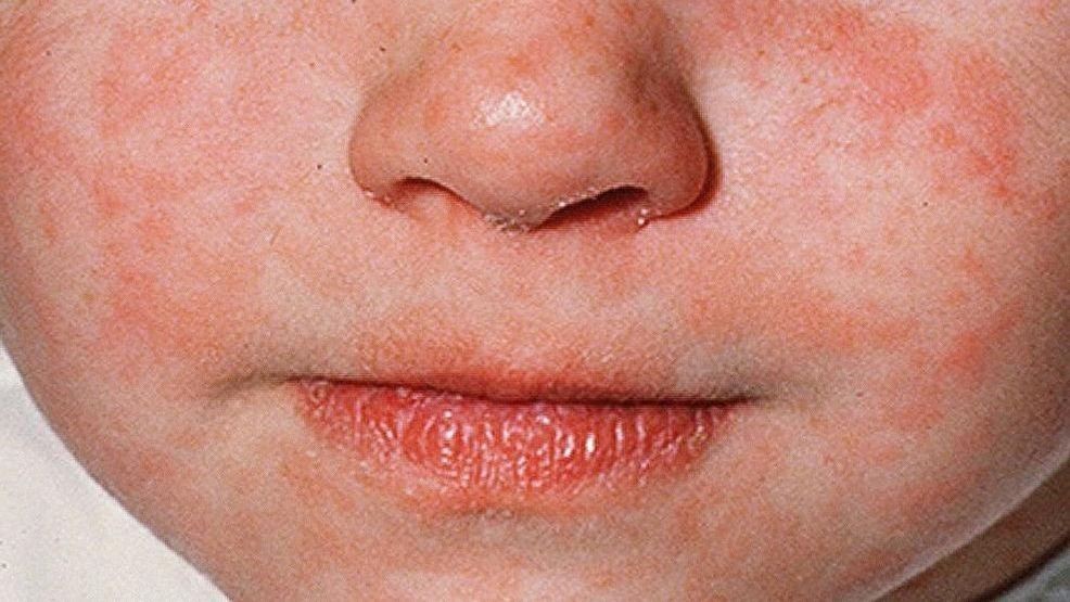 King County infant diagnosed with measles; multiple public exposure sites identified