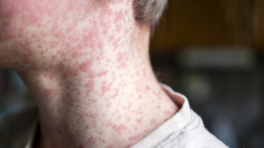 As measles cases rise in the U.S., some adults may need a vaccine booster : Shots