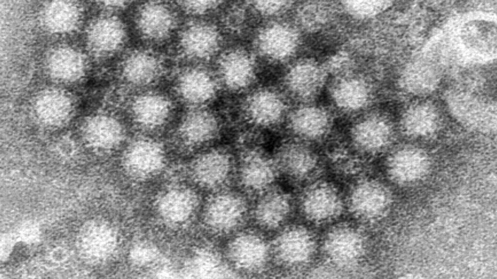 The horrendous norovirus is hitting Florida hard. How to protect yourself.