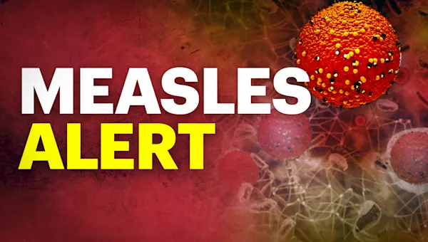 Suffolk County child tests positive for measles