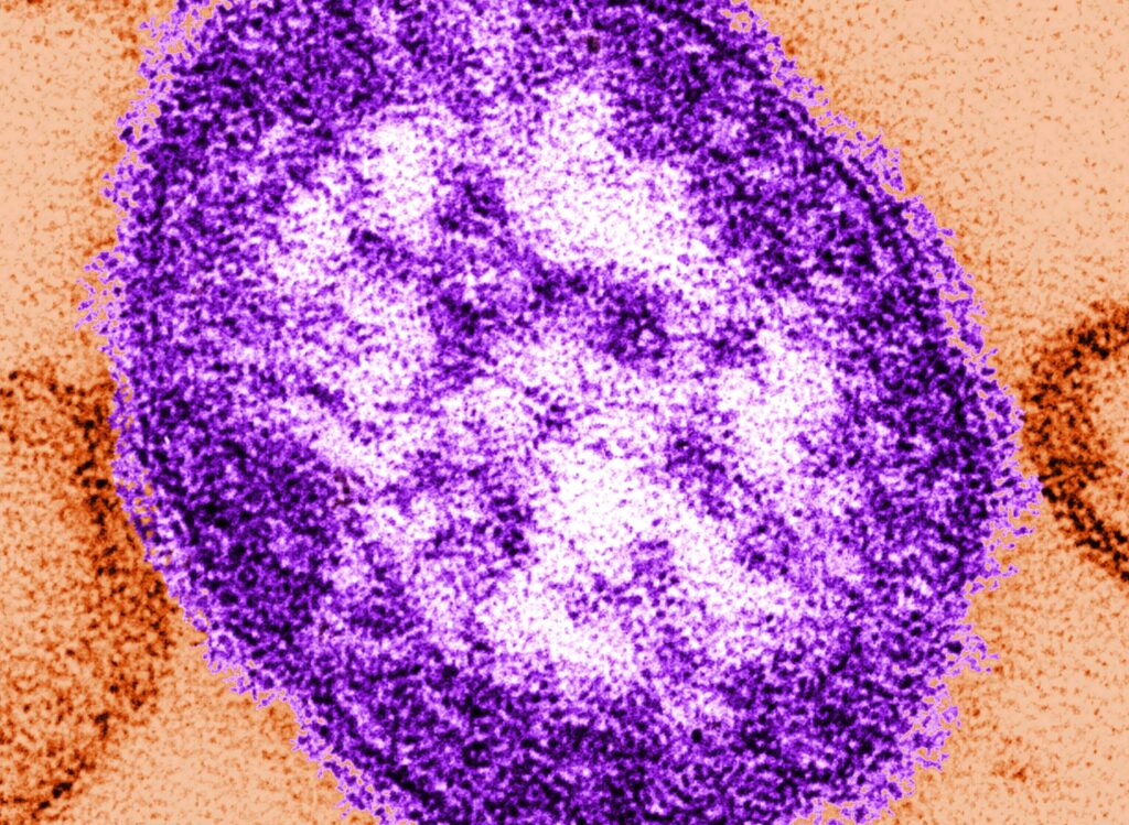 Measles confirmed in unvaccinated Montgomery County child