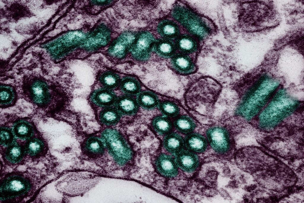 Michigan Resident Dies From Donated Kidney Tainted With Rabies