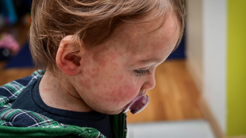 Measles can still harm health even years after an infection : Shots