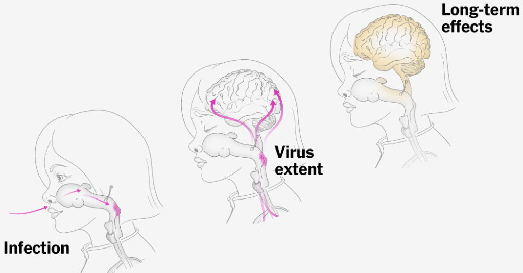 How Measles Attacks an Unvaccinated Child