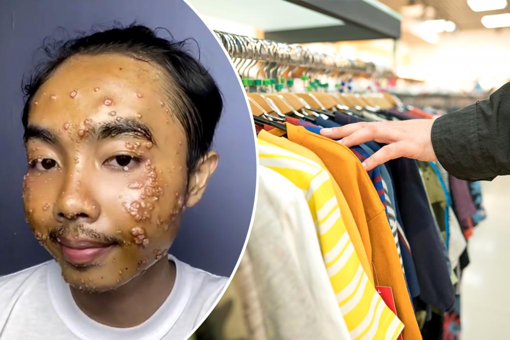 Man got skin condition from thrifted clothes