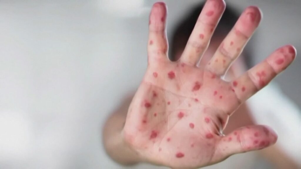 5 new measles cases confirmed in Indiana: IDOH reports