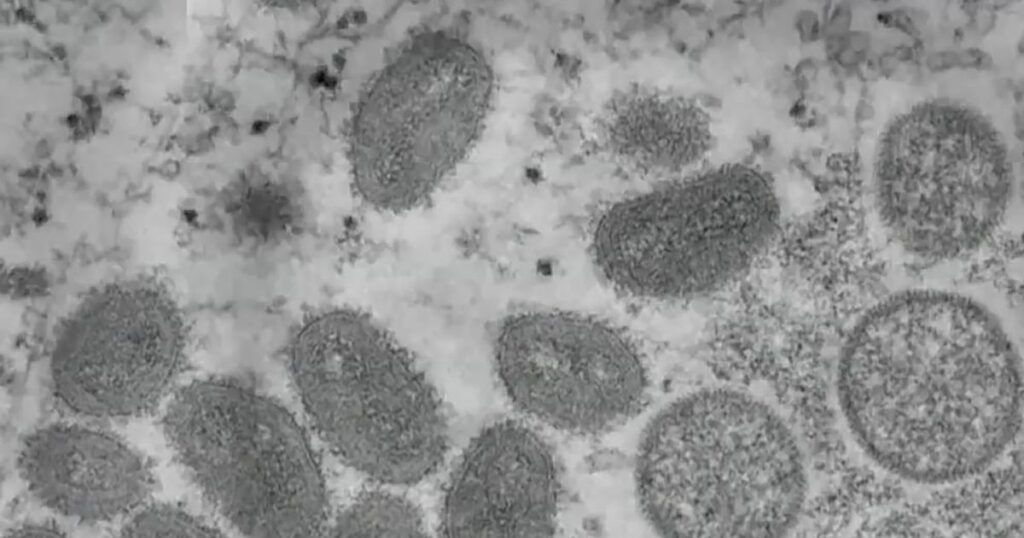 Mpox found in sewage samples from Greenville plant :: WRAL.com