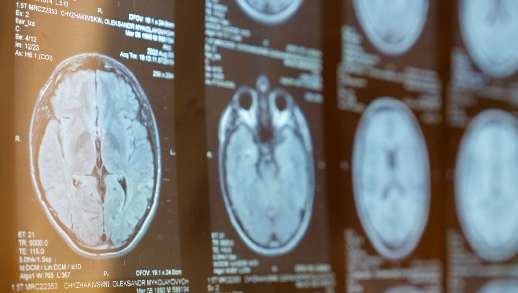 How The Epstein-Barr Virus Causes Multiple Sclerosis – And Where Science Is On A Cure