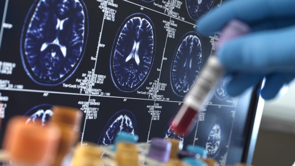 Latest Alzheimer’s lab tests focus on memory loss, not brain plaques : Shots