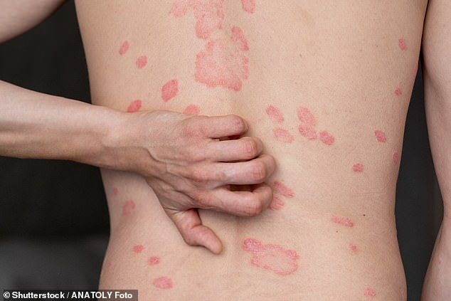 Strange link discovered between painful skin disease and stubborn belly fat