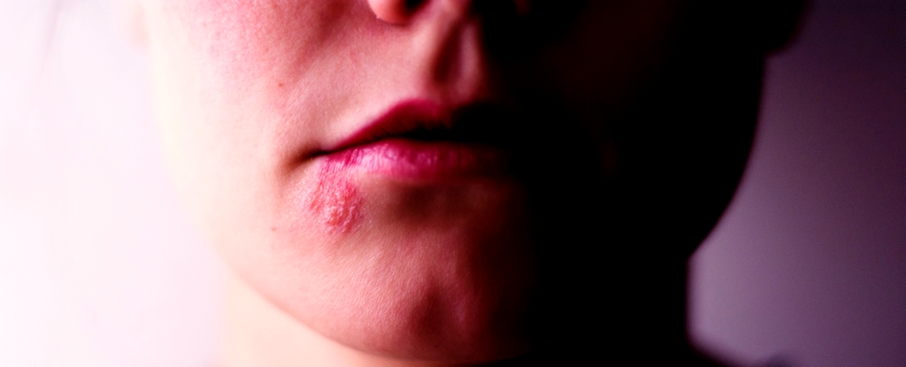 New Link Connects Herpes to Alzheimer's. Here's What We Know. : ScienceAlert