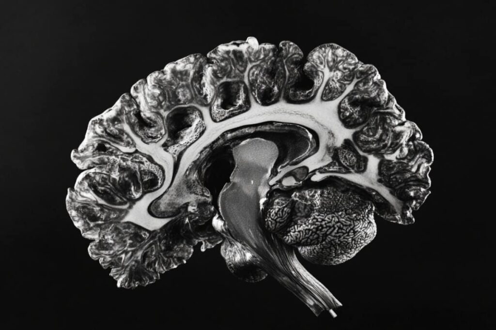 8-Minute MRI Scan Can Diagnose MS Without Lumbar Puncture