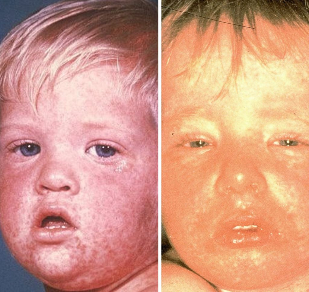 Measles Case Confirmed in Williamsburg