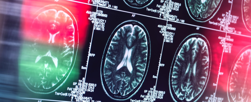 Alzheimer's Might Not Actually Be a Brain Disease, Says Expert : ScienceAlert