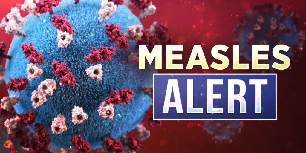 Measles case confirmed in eastern Iowa