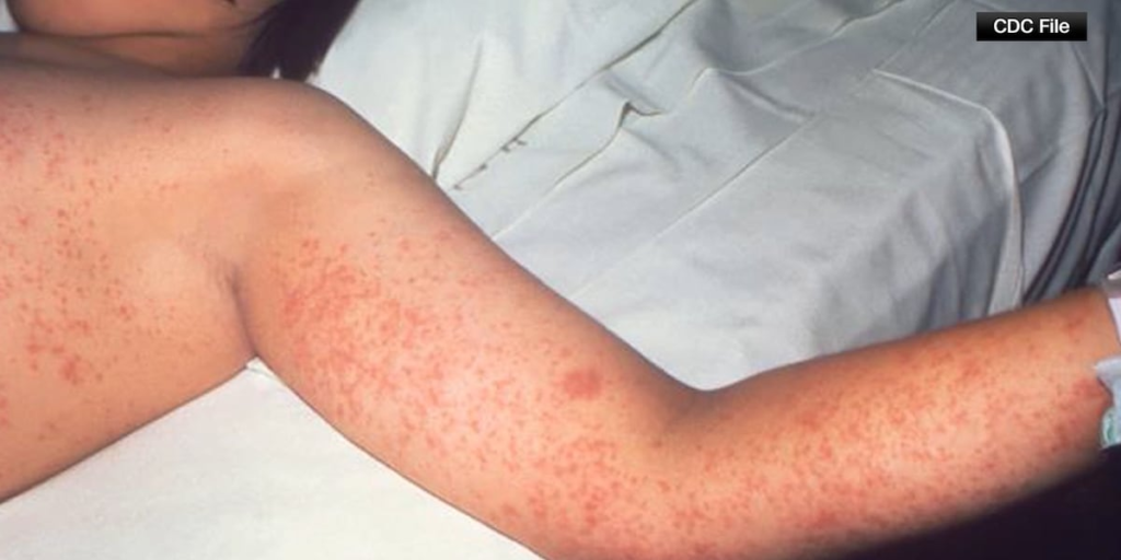 Measles confirmed in Colorado Springs, public asked to watch for symptoms
