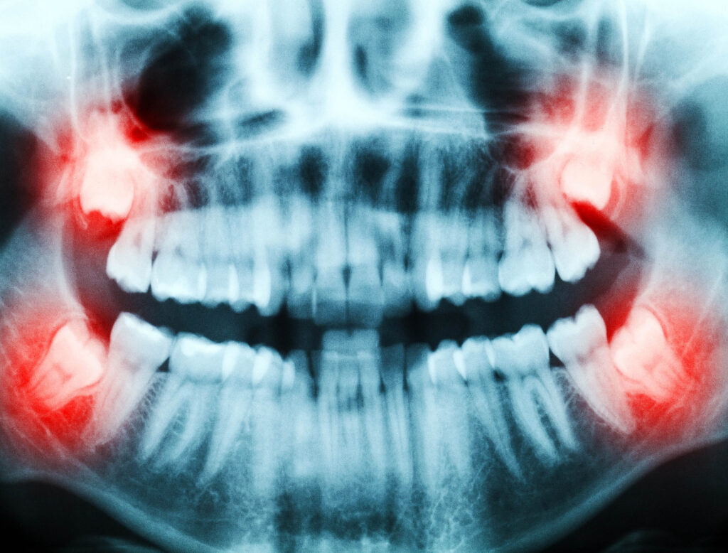 Stem cells from wisdom teeth could help treat multiple diseases