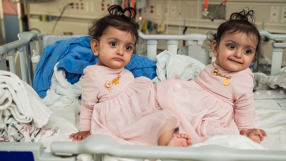 Conjoined twin girls undergo rare separation surgery at Seattle Children's Hospital