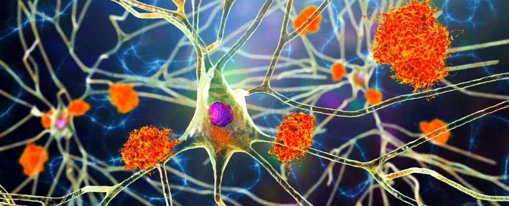 A Study of 500,000 Medical Records Linked Viruses With Alzheimer's Again And Again : ScienceAlert