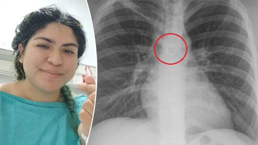TikTok user reports that swallowed nose ring was located only 0.5mm from her aorta